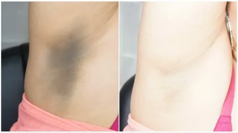 Depilação a Laser Clareia a Pele