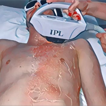 depilação a luz pulsada